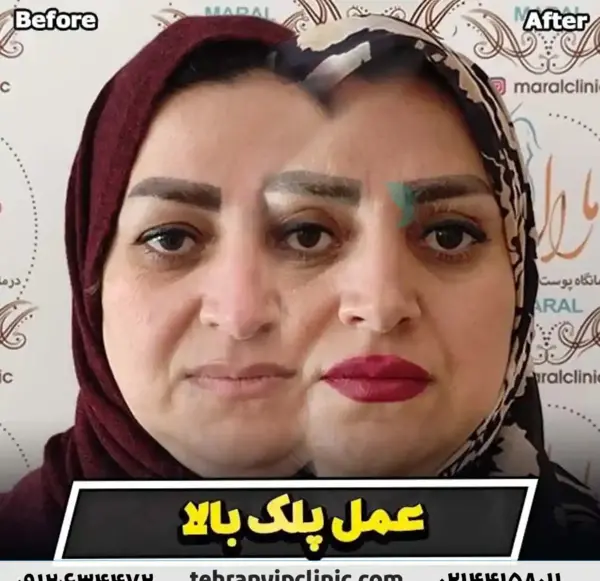 عکس قبل از عمل چشم
