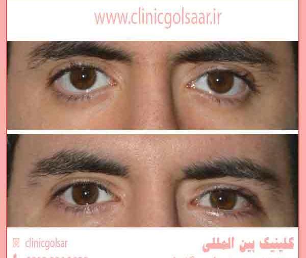 عکس قبل از عمل چشم