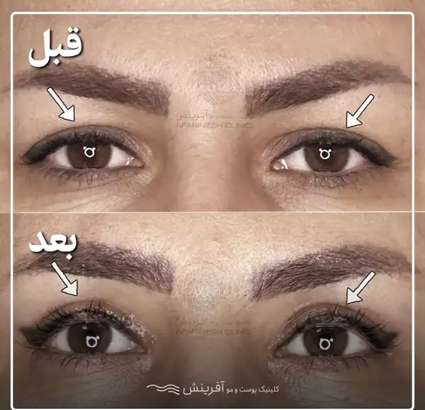 عکس قبل از عمل چشم