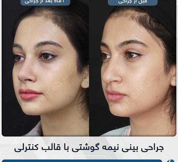 عکس قبل از عمل چشم