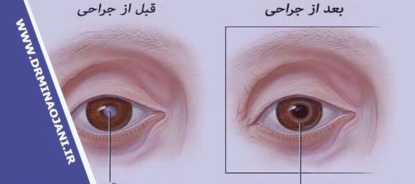 عکس قبل از عمل چشم