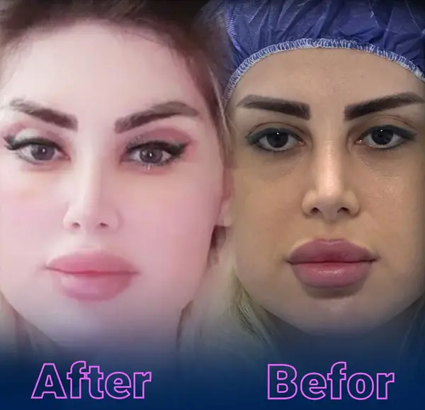 عکس قبل از عمل چشم