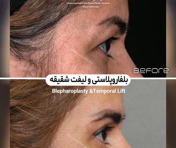 عکس قبل از عمل چشم