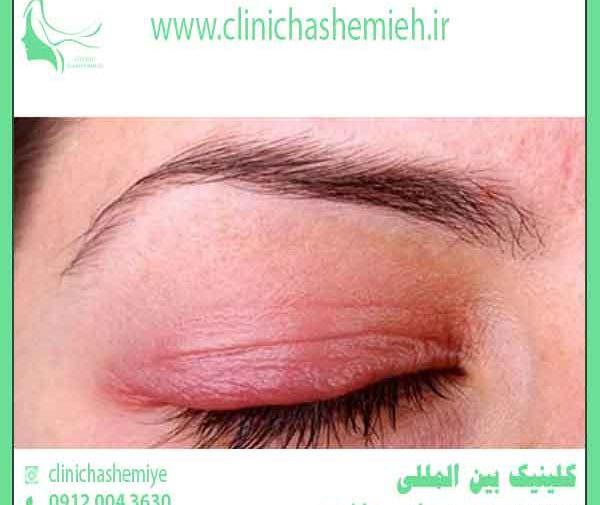 عکس قبل از عمل چشم
