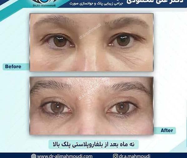 عکس قبل از عمل چشم