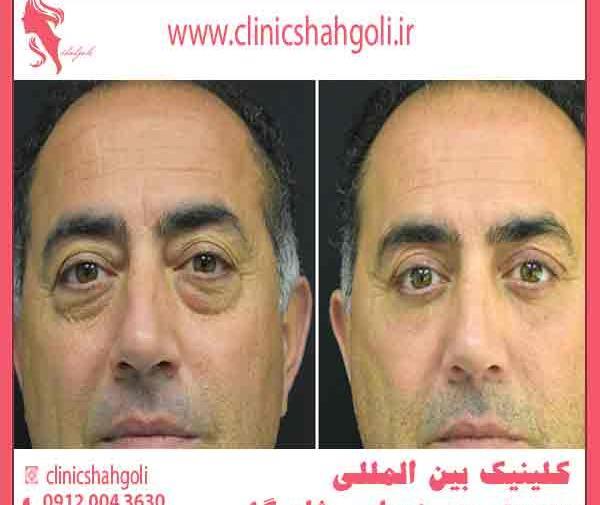 عکس برداری قبل از عمل چشم