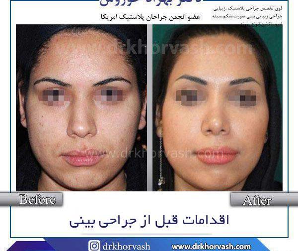 عکس برداری قبل از عمل چشم