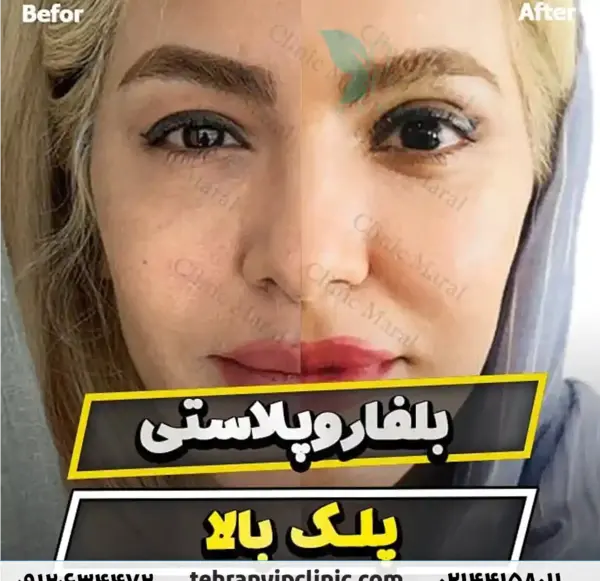 عکس برداری قبل از عمل چشم