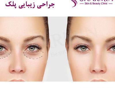 عکس برداری قبل از عمل چشم