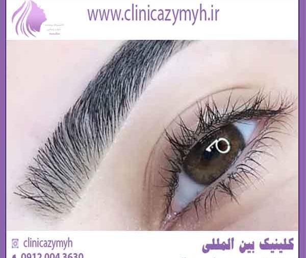 عکس برداری قبل از عمل چشم