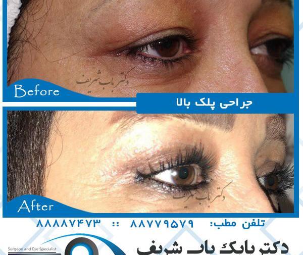 عکس برداری قبل از عمل چشم