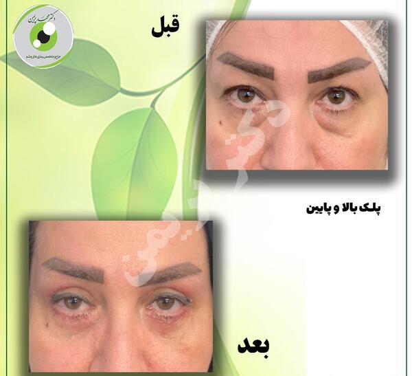 عکس برداری قبل از عمل چشم