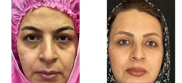 عکس های قبل از عمل چشم