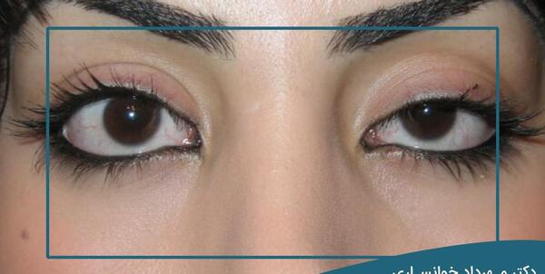 عکس های قبل از عمل چشم
