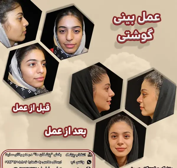 عکس های قبل از عمل چشم