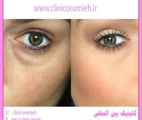 عکس های قبل از عمل چشم