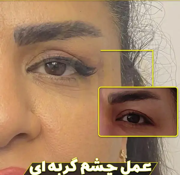 عکس های قبل از عمل چشم