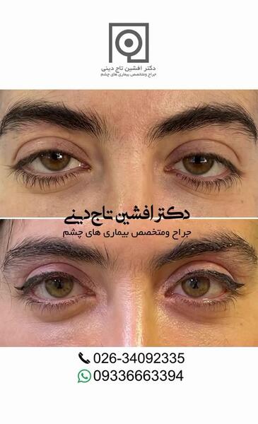 عکس های قبل از عمل چشم