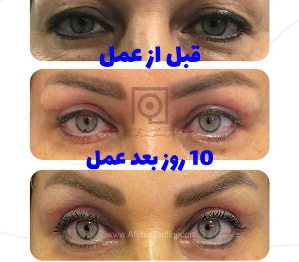 عکس های قبل از عمل چشم
