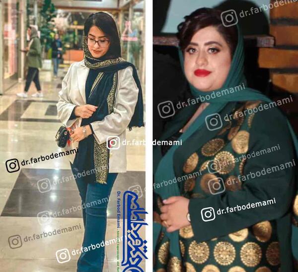 عکس قبل بعد چاقی
