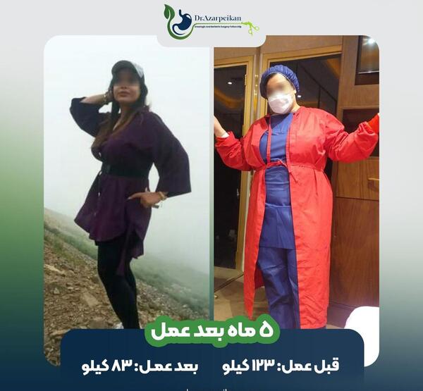 عکس قبل بعد چاقی