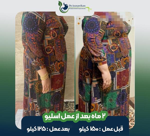 عکس قبل بعد چاقی