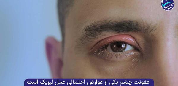 عکس از چشم قبل از عمل لیزیک