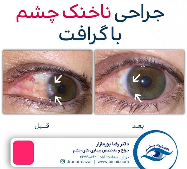 عکس از چشم قبل از عمل لیزیک