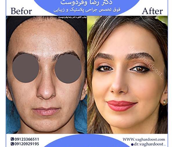 عکس های قبل از جراحی بینی