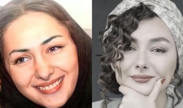 عکس های قبل از جراحی بینی