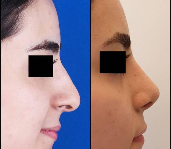 عکس های قبل از جراحی بینی