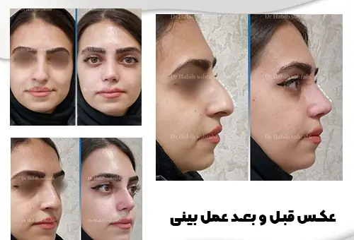 عکس های قبل از جراحی بینی