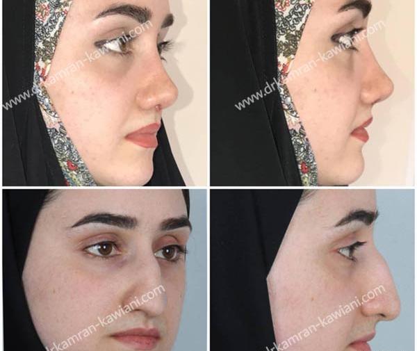عکس های قبل از جراحی بینی