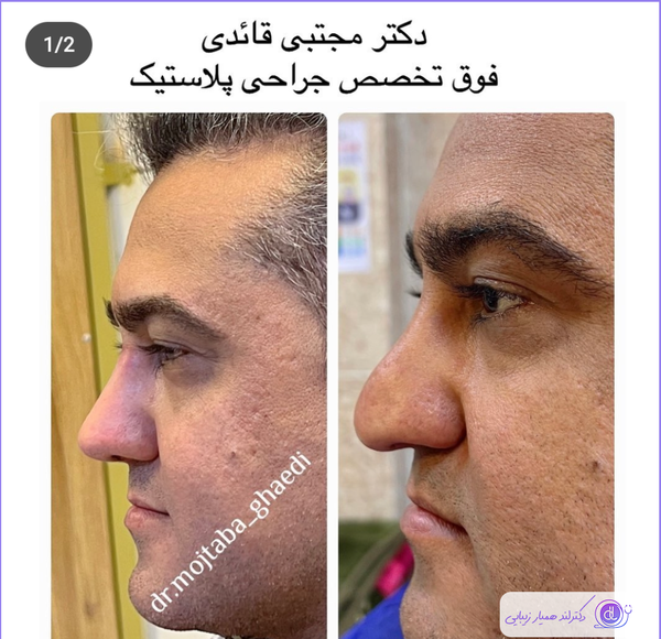 عکس های قبل از جراحی بینی