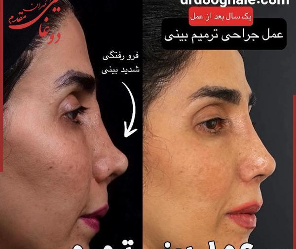 عکس های قبل از جراحی بینی