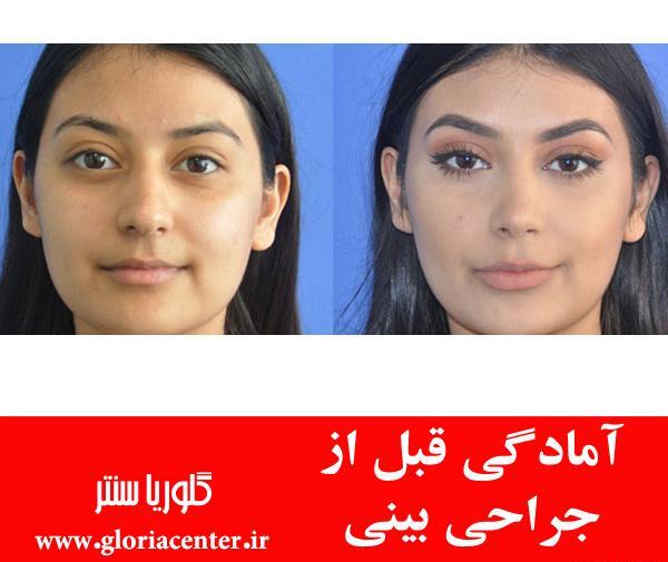 عکس های قبل از جراحی بینی