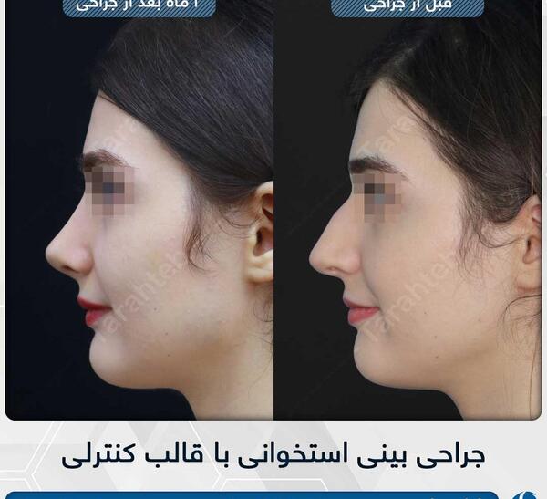 عکس های قبل از جراحی بینی