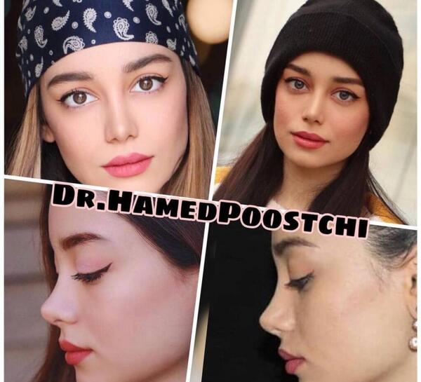 عکس های قبل از جراحی بینی