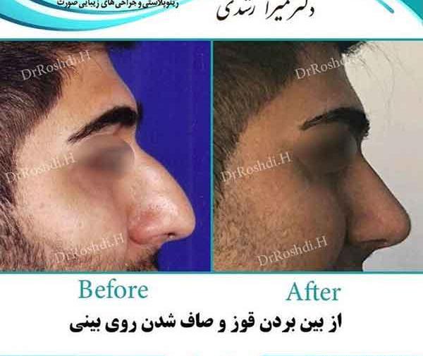 عکس های قبل از جراحی بینی