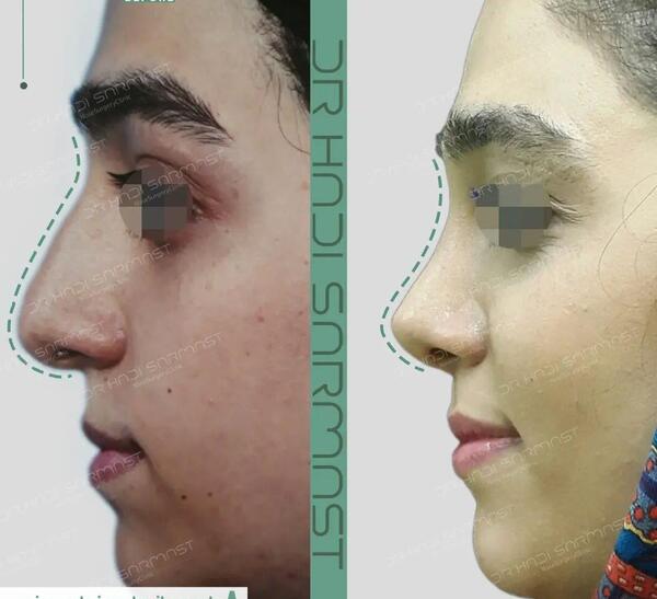 عکس های قبل از جراحی بینی