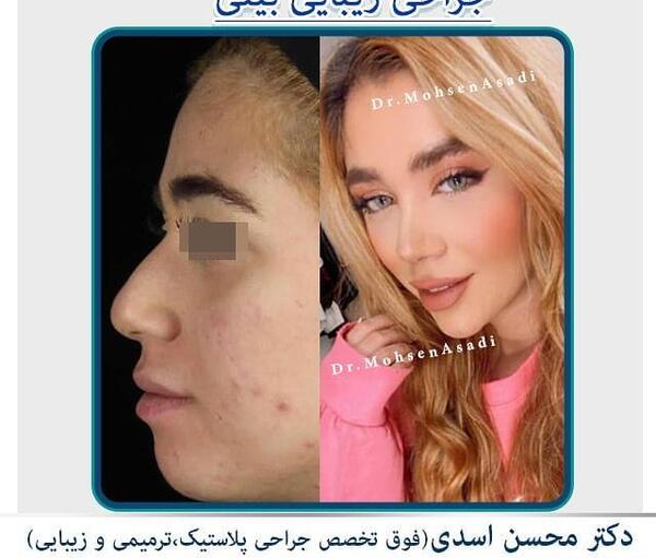 عکس های قبل از جراحی بینی