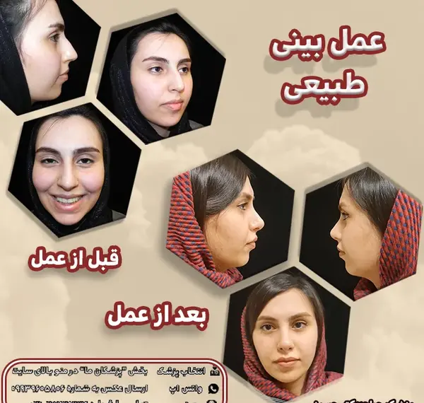 عکس جراحی بینی قبل و بعد از عمل