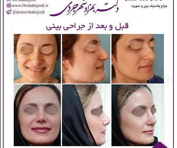 عکس جراحی بینی قبل و بعد از عمل