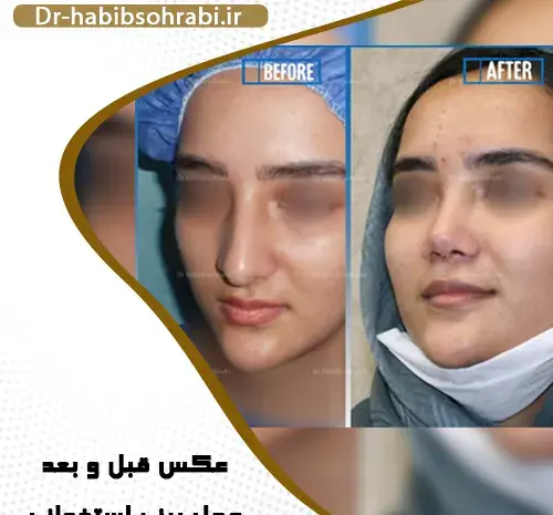 عکس جراحی بینی قبل و بعد از عمل