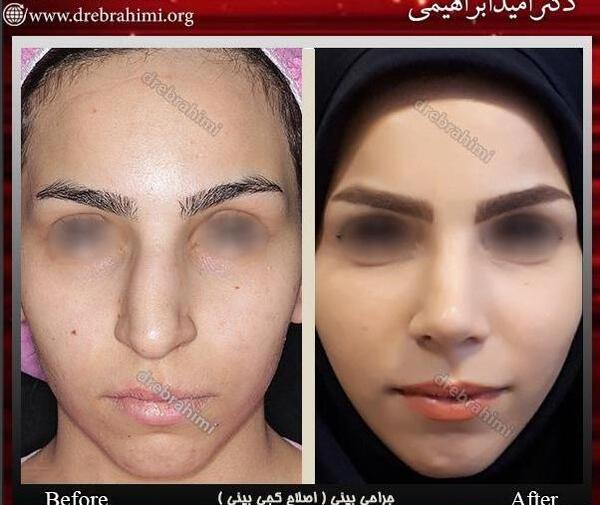 عکس جراحی بینی قبل و بعد از عمل