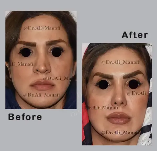 عکس جراحی بینی قبل و بعد از عمل