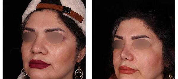 عکس جراحی بینی قبل و بعد از عمل