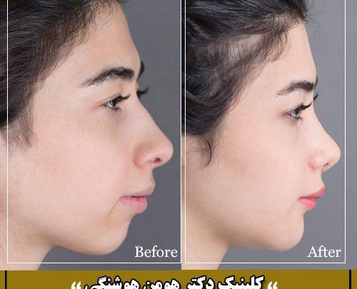 عکس جراحی بینی قبل و بعد از عمل