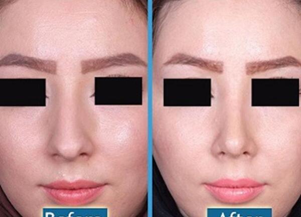 عکس برداری قبل از جراحی بینی
