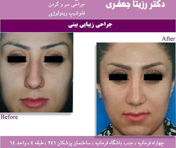 عکس برداری قبل از جراحی بینی